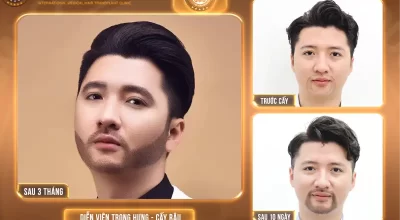 Cấy râu quai nón tự thân: Quy trình, phương pháp và chi phí