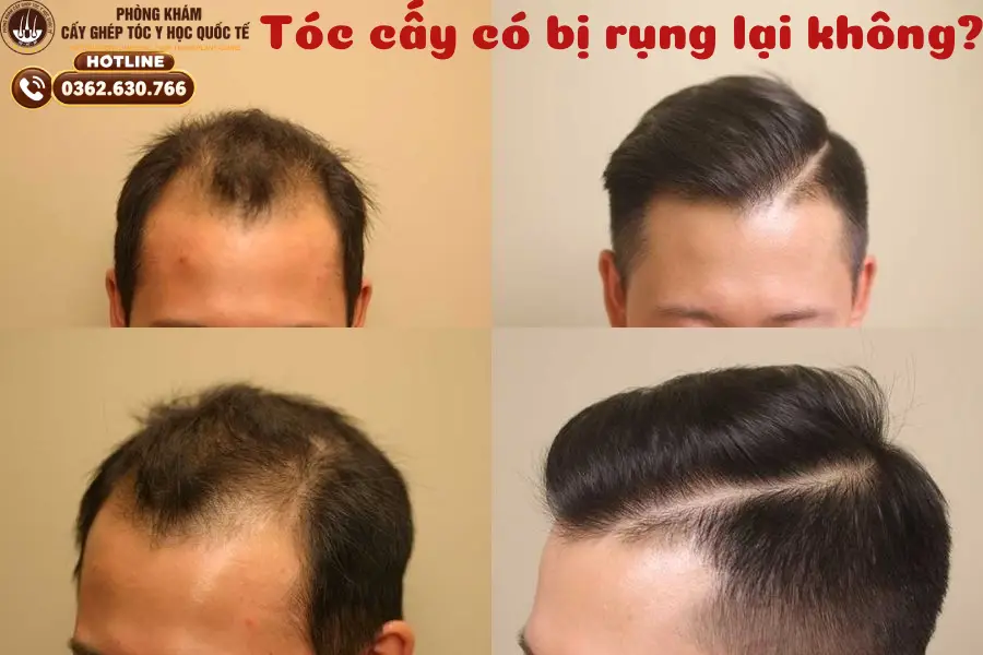 cấy tóc có bị rụng lại không