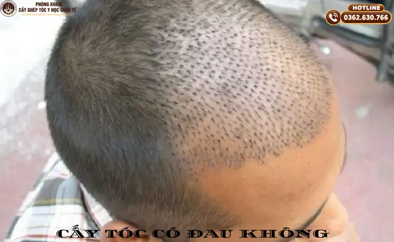cấy tóc có đau không