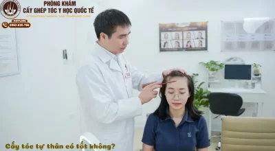 Cấy tóc tự thân có tốt không? Các phương pháp cấy tóc có hiệu quả