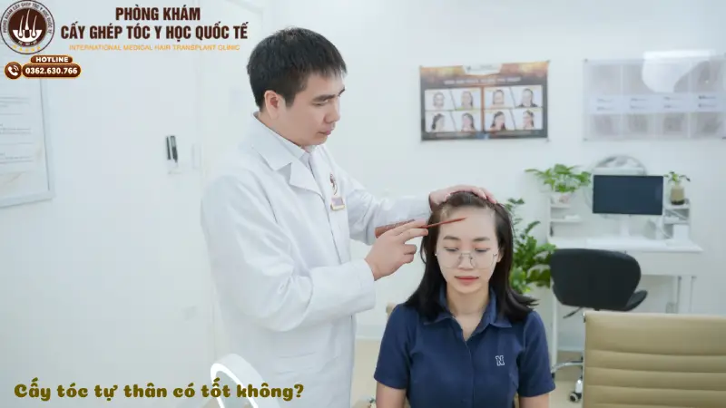 Cấy tóc tự thân có tốt không