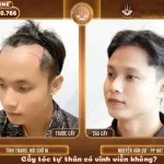 Cấy tóc tự thân có vĩnh viễn không
