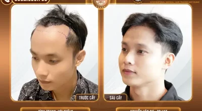 Cấy tóc tự thân có vĩnh viễn không? Giữ được bao lâu