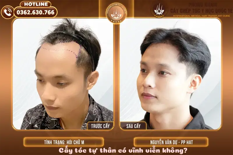Cấy tóc tự thân có vĩnh viễn không