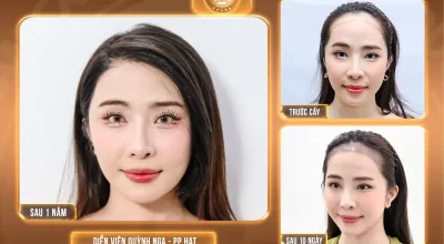 Cấy tóc tự thân là gì? Chỉ định, Quy trình, Hiệu quả bao lâu