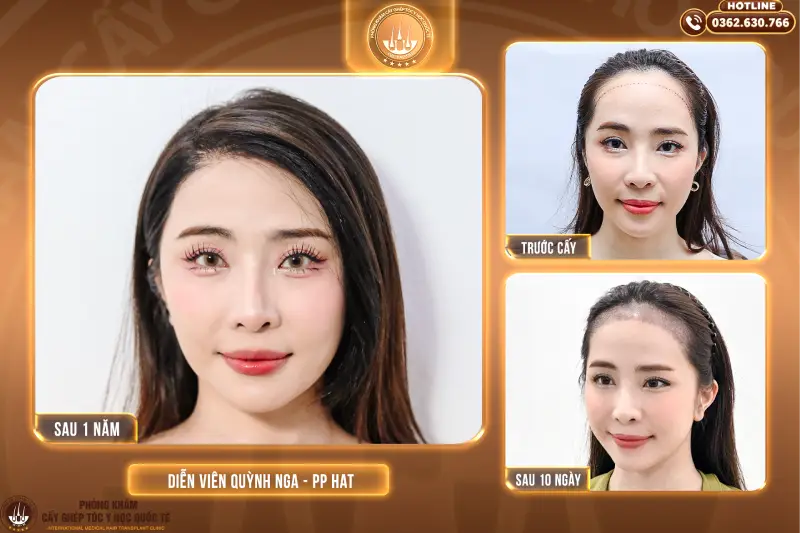 cấy tóc tự thân là gì