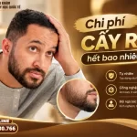 chi phí cấy râu hết bao nhiêu tiền
